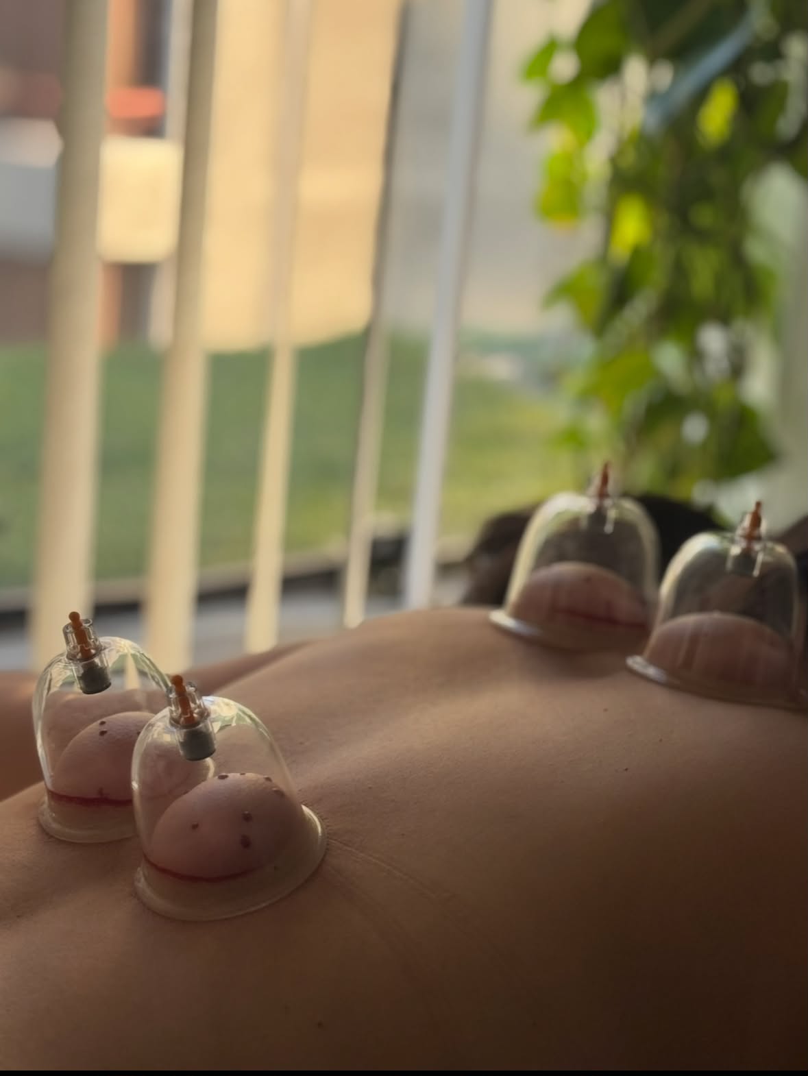 Terapia de ventosas sobre la espalda de un paciente